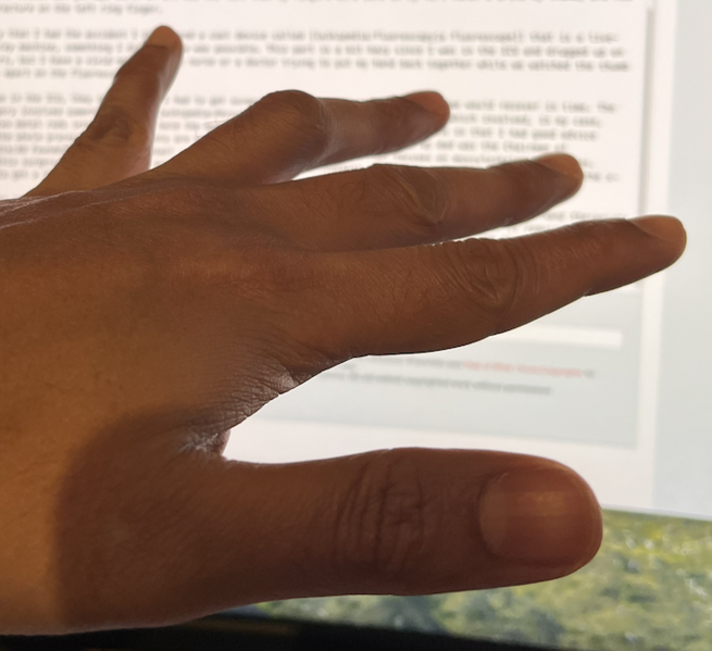 File:Roshan's Hand With Bent Ring Finger.png
